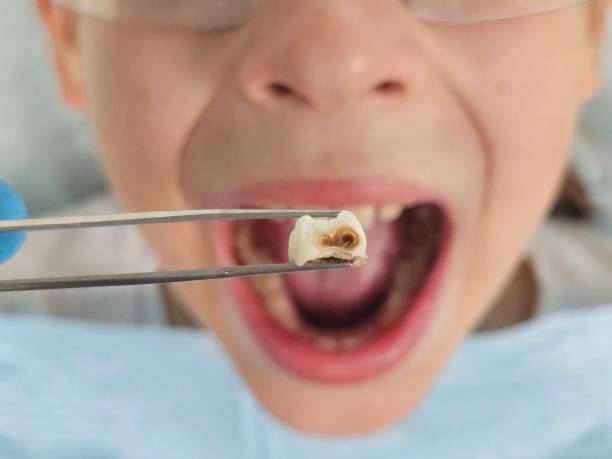 Best Chipped Tooth Repair Near Me  in Hampton, VA